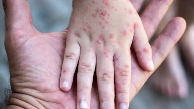 Chiapas suma 920 casos de sarampión y se ubica tercero a nivel nacional