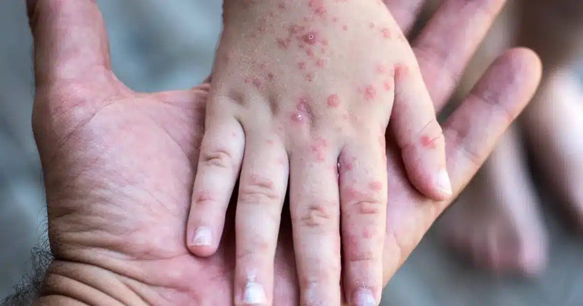Chiapas suma 920 casos de sarampión y se ubica tercero a nivel nacional