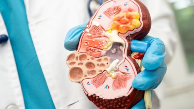Daño renal por hipertensión crece 6.7% anual en Chiapas, revela estudio de Ecosur